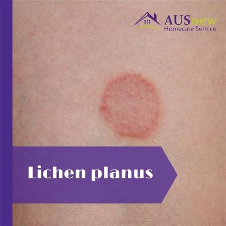 What does vulvar lichen planus look like