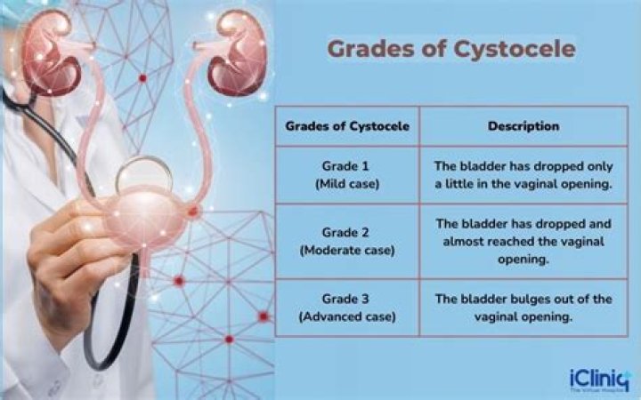 What grade is a midline Cystocele