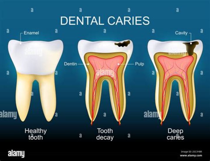 What hand instrument is used to remove decayed dentin from a cavity