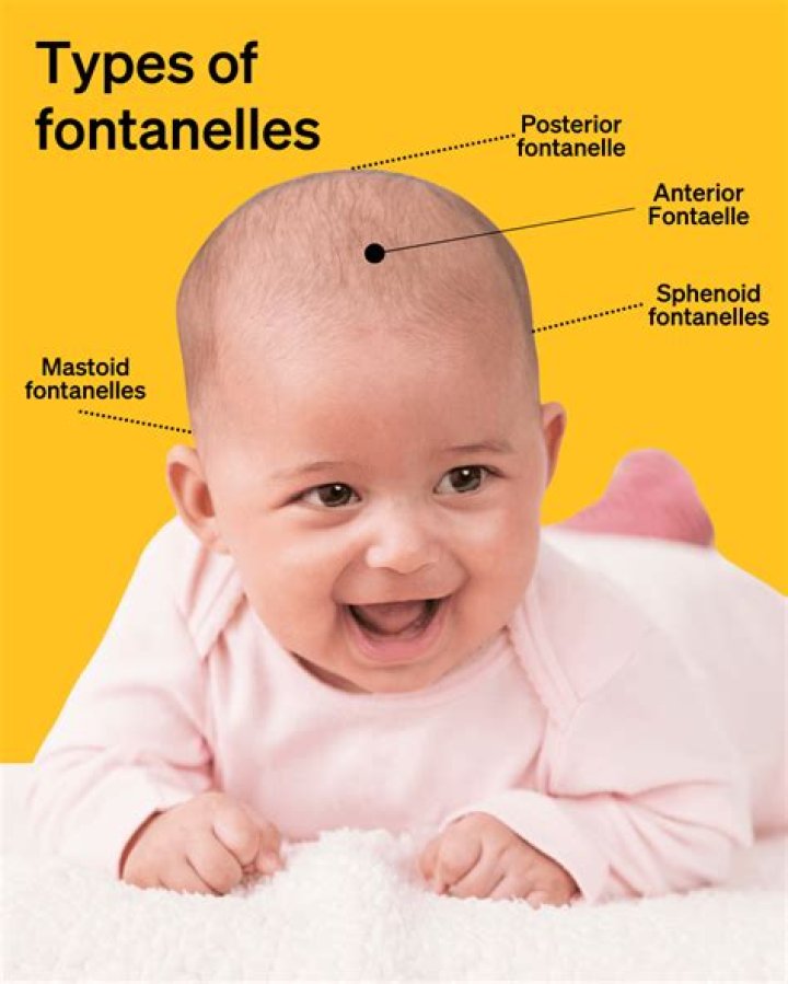 What happens if anterior fontanelle doesnt close