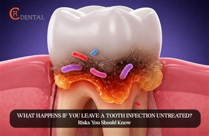 What happens if you leave a pilonidal cyst untreated