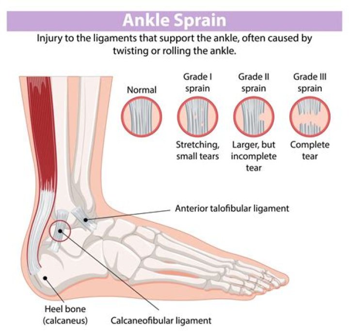 What happens when you have a high ankle sprain
