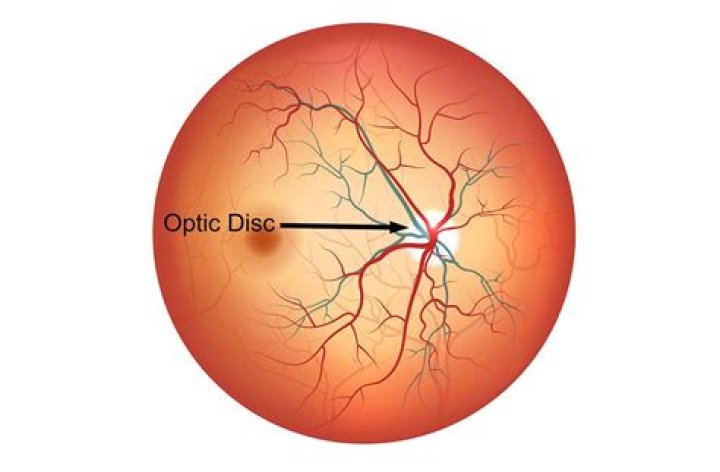 What is a blurred optic disc