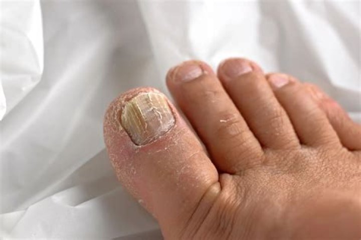What is a bright nail