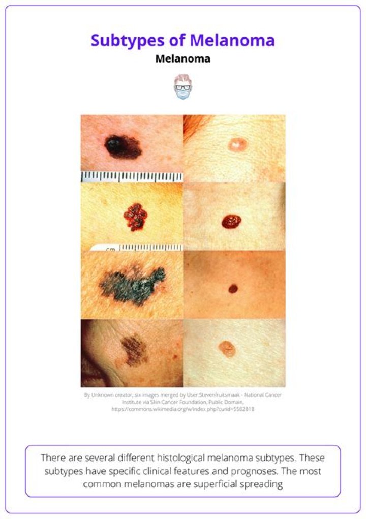 What is a characteristic of malignant melanoma