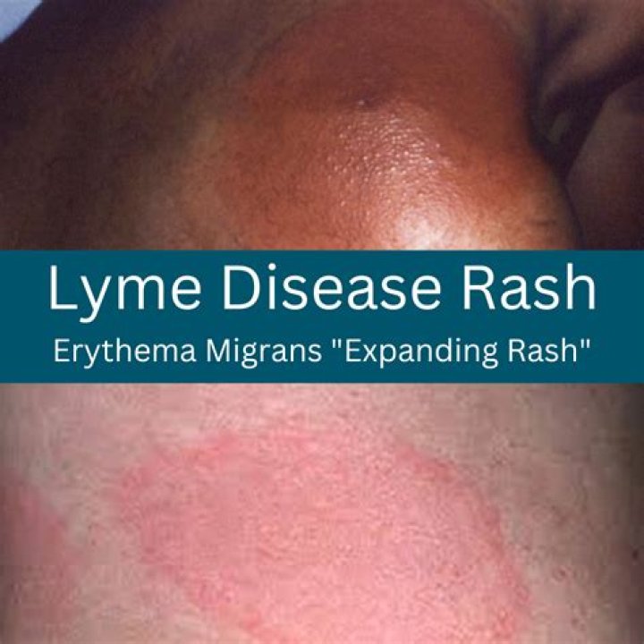 What is a erythema migrans