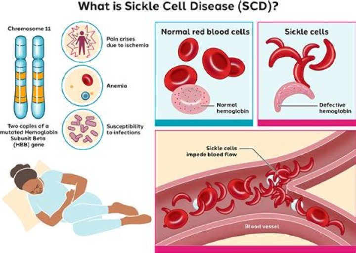 What is a good indicator of sickle cell disease