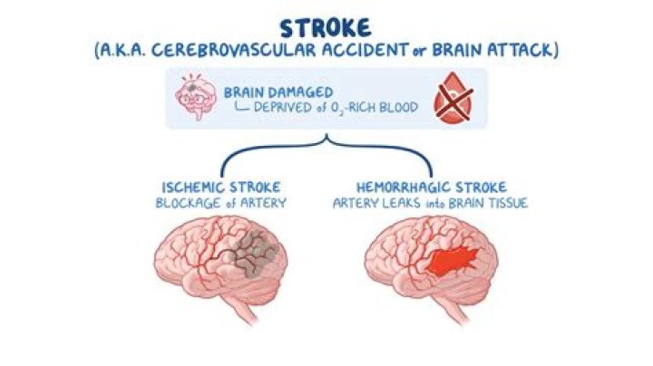 What is a Laci stroke
