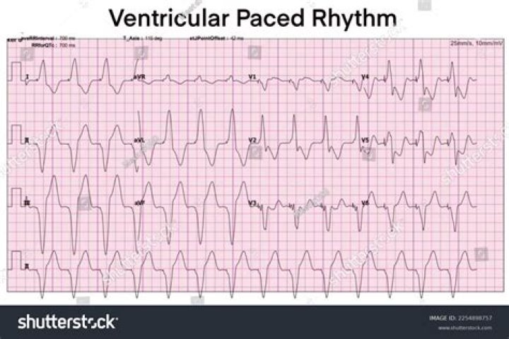 What is a paced rhythm