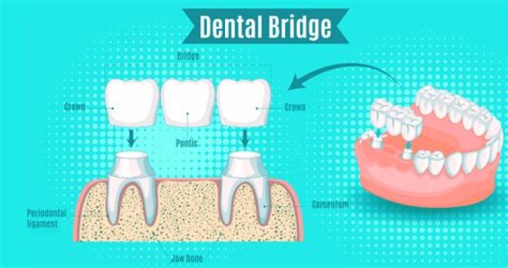 What is a Pontic in dentistry