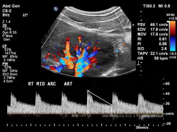 What is a renal Doppler ultrasound