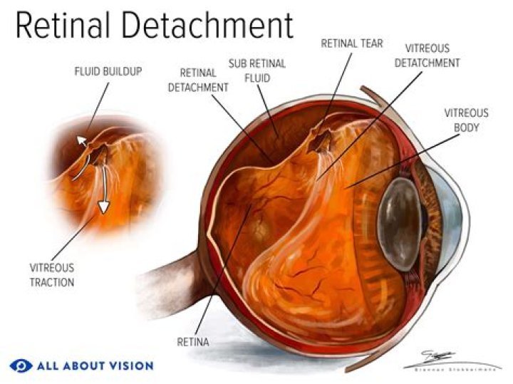 What is a retinal break