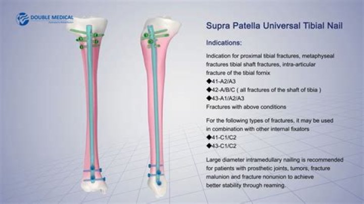 What is a tibial nail