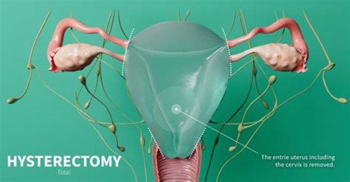 What is a TLH hysterectomy