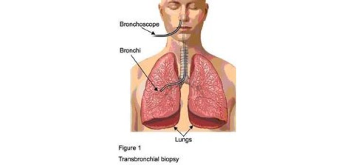 What is a transbronchial biopsy