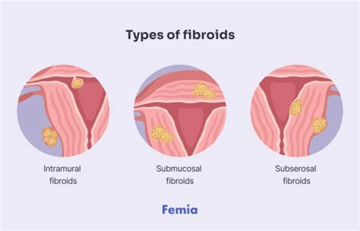 What is a transmural fibroid