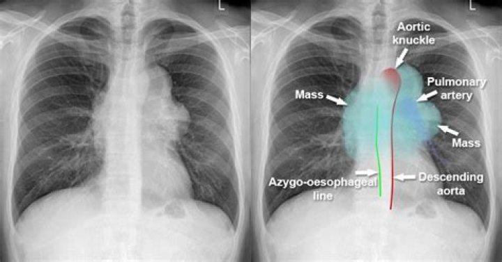 What is an anterior mediastinal mass