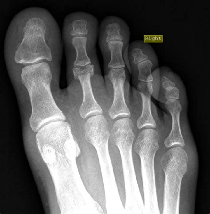 What is an oblique xray