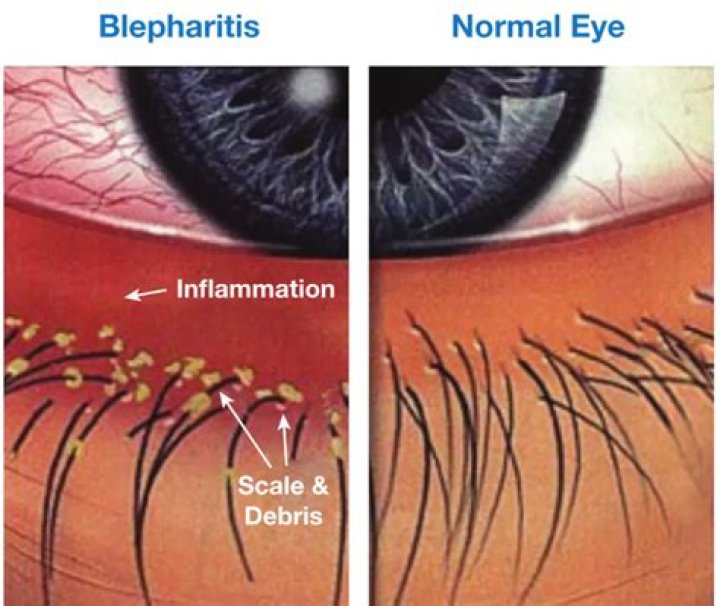 What is angular Blepharoconjunctivitis