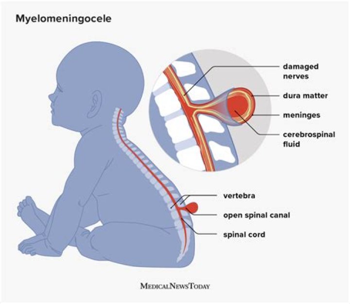 What is another name for myelomeningocele