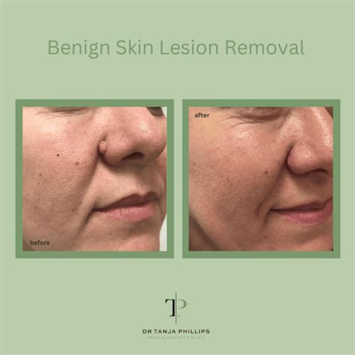 What is benign skin lesion