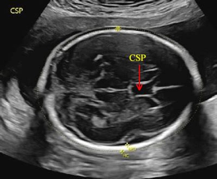 What is CSP in fetus