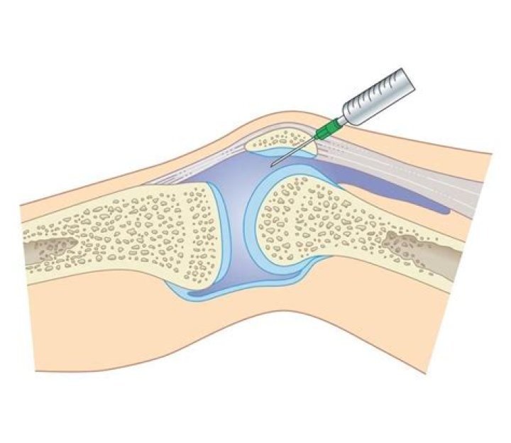 What is done during an arthrocentesis