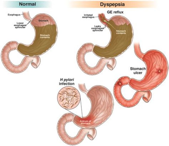 What is dyspepsia of the stomach