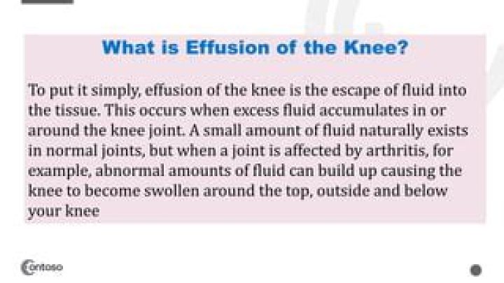 What is effusion of knee