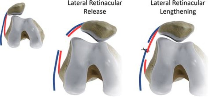 What is lateral Retinacular release