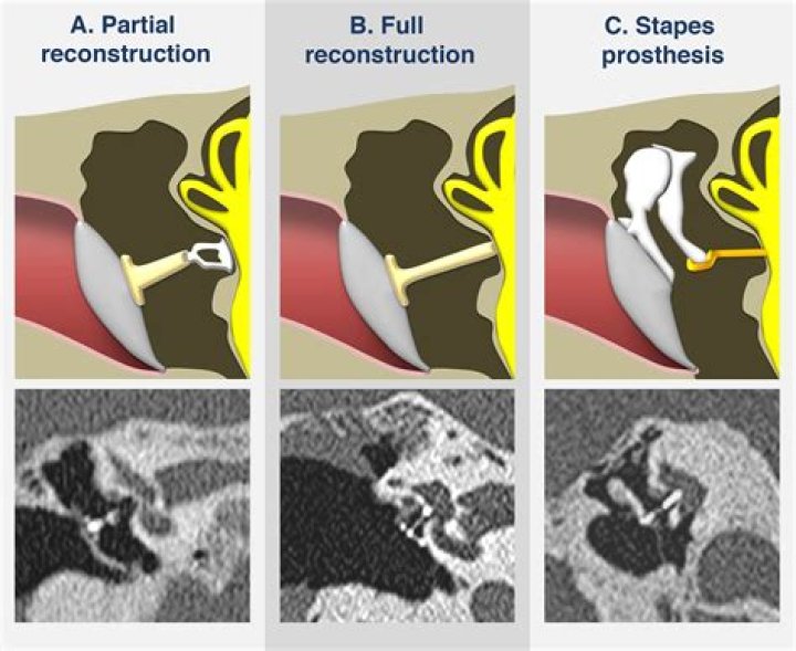 What is Ossicular reconstruction