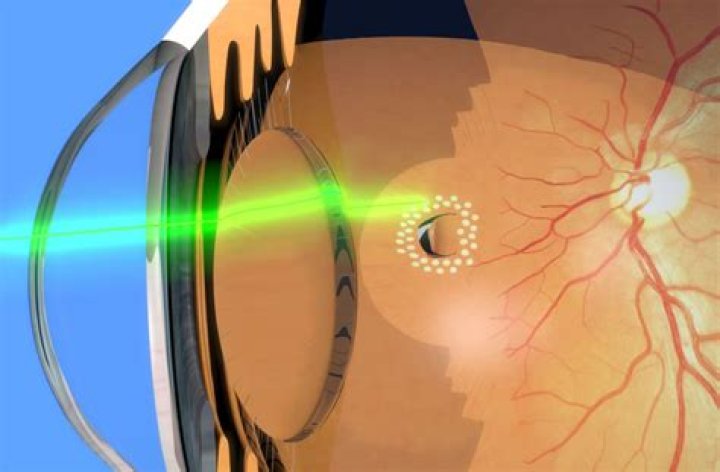 What is Panretinal laser photocoagulation
