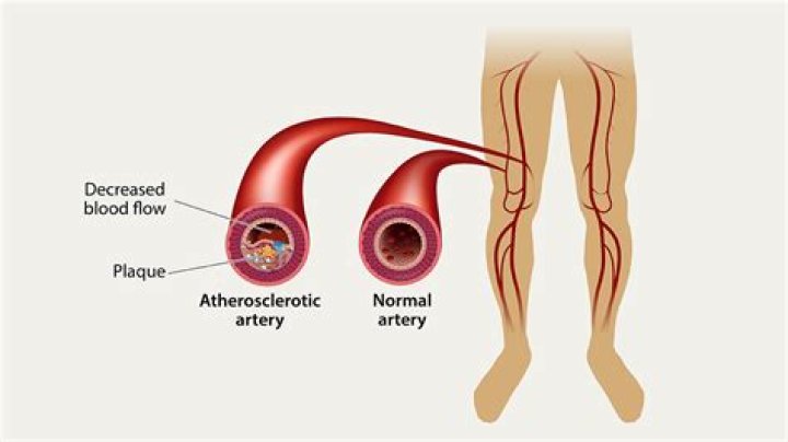 What is peripheral stenosis