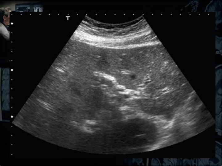 What is Periportal cuffing