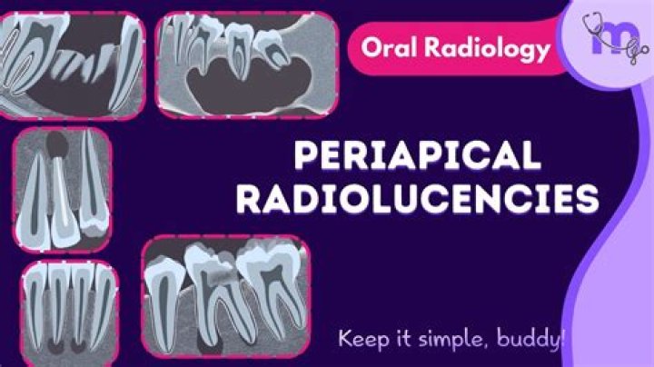 What is Periradicular Radiolucency