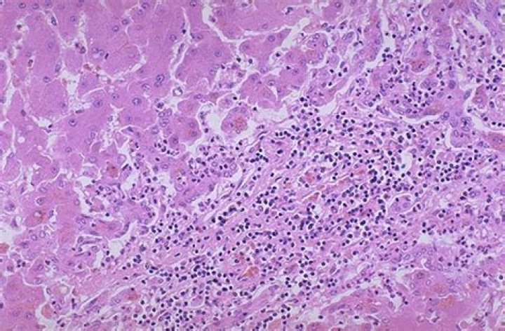 What is piecemeal necrosis