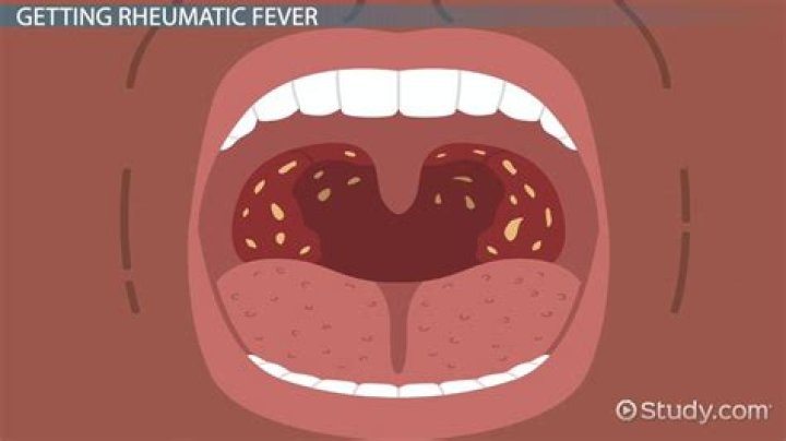 What is rheumatic Valvulitis