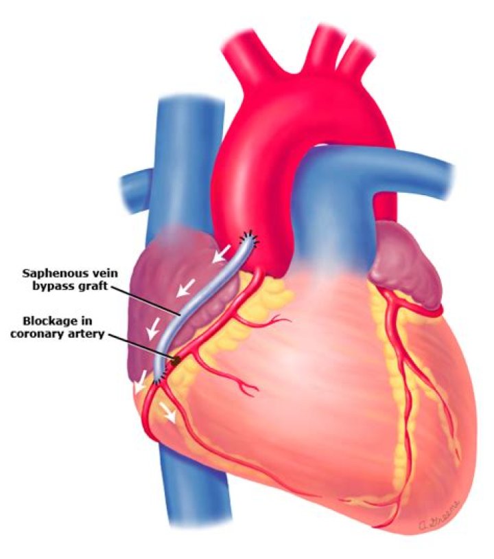 What is saphenous vein bypass graft