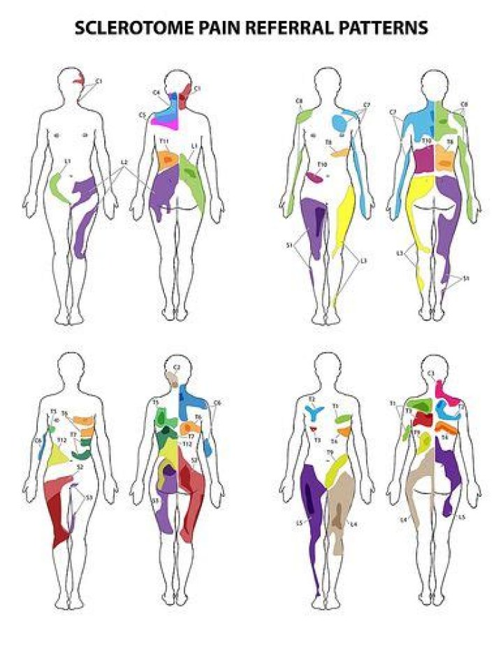 What is Sclerotome pain