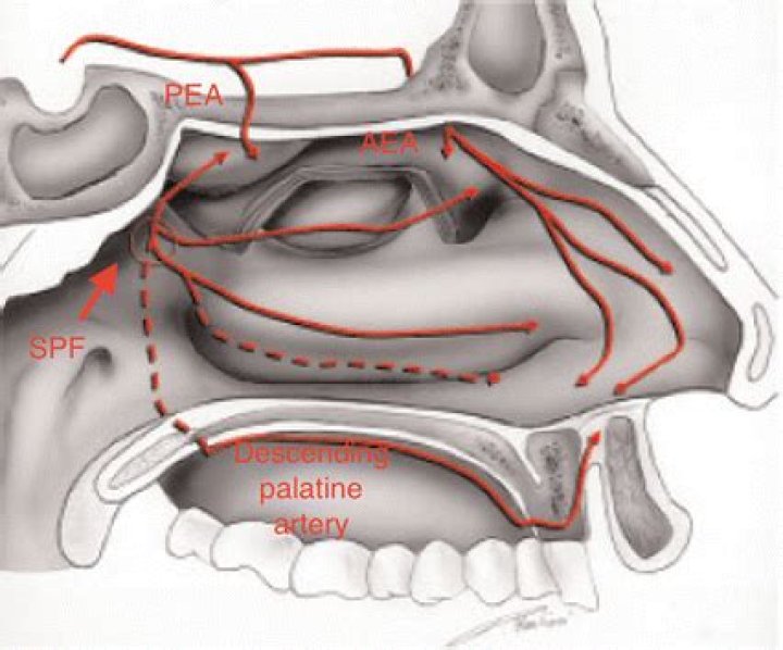 What is sphenopalatine artery ligation