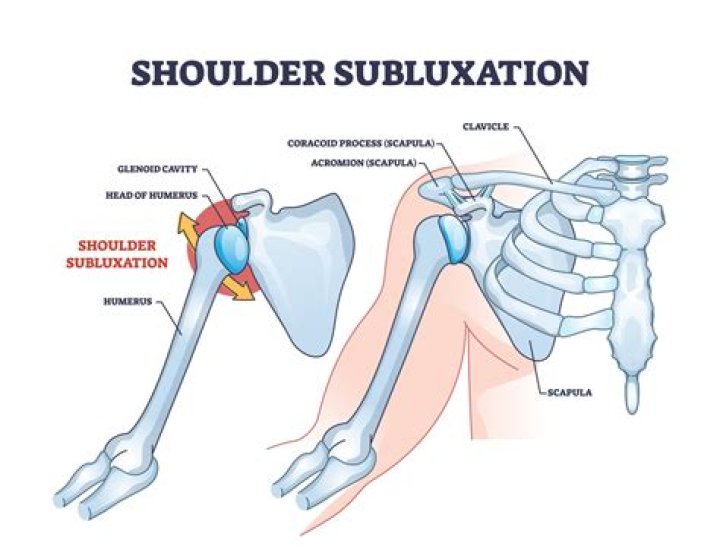 What is subluxation theory