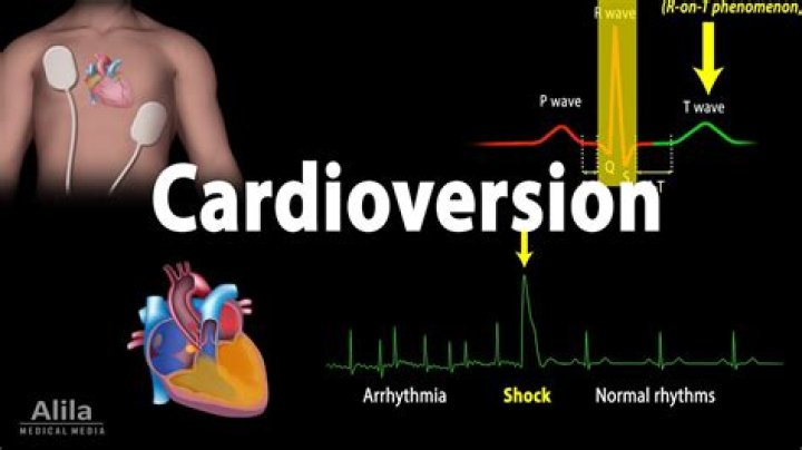 What is Synchronised cardioversion