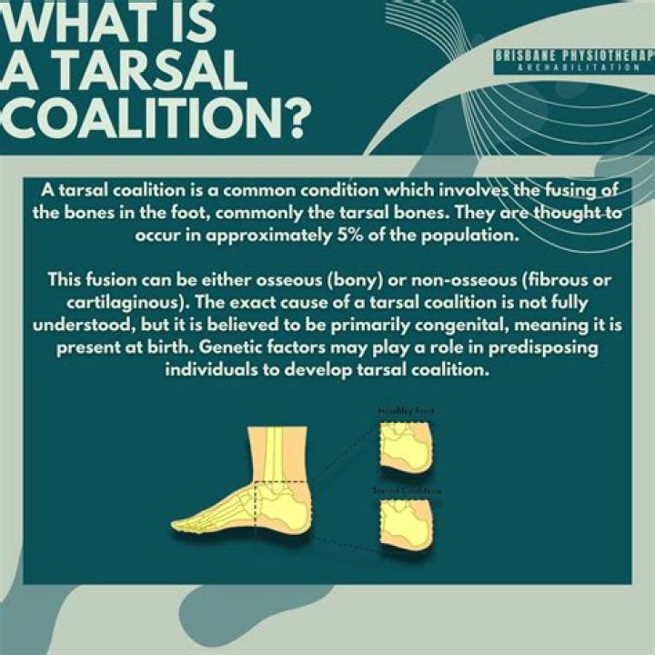What is tarsal coalition