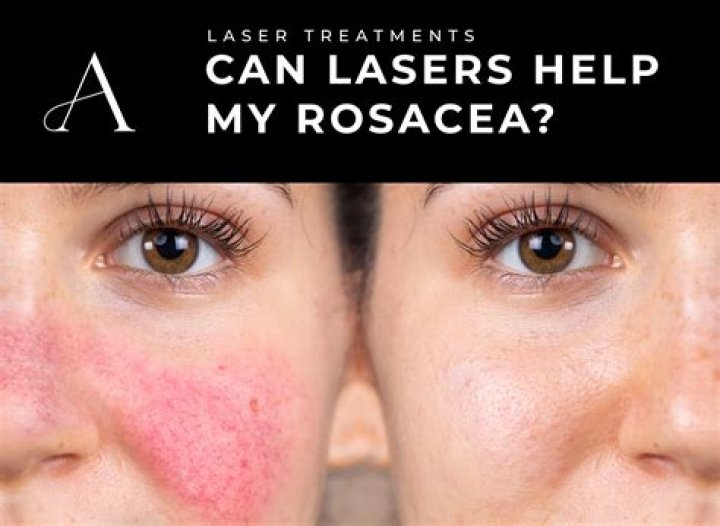 What is the best treatment for ocular rosacea