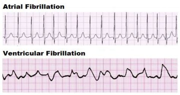 What is the difference between a fib and V fib