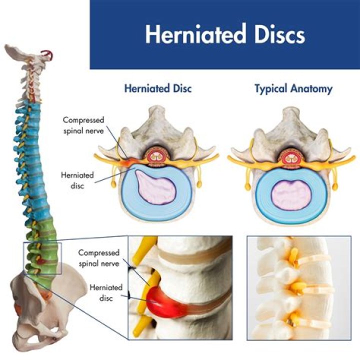 What is the difference between a herniated disc and an extruded disc
