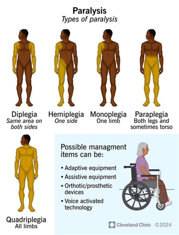 What is the difference between paraplegia and hemiplegia