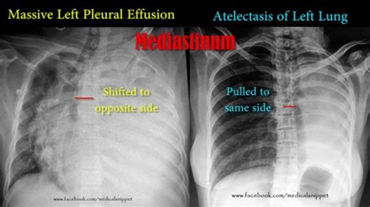 What is the difference between pleural effusion and pneumothorax