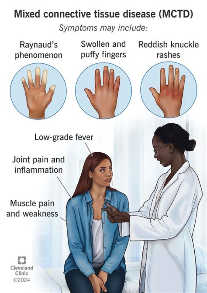 What is the life expectancy of someone with mixed connective tissue disease