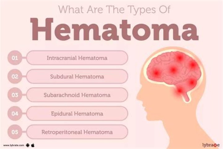 What is the meaning of the root in the term hematoma